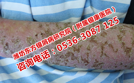 得了牛皮癬有什么危害