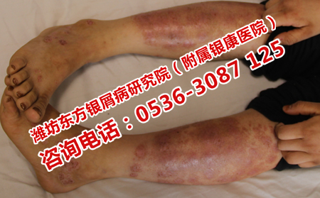 牛皮癬患者怎樣解決營養不良