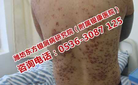 牛皮癬患者日常吃點什么理想