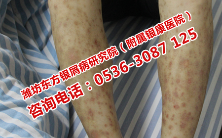 牛皮癬恢復受阻的原因