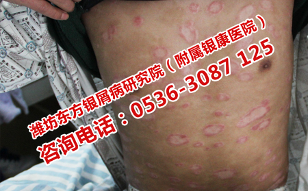 銀屑病對老人的危害有哪些