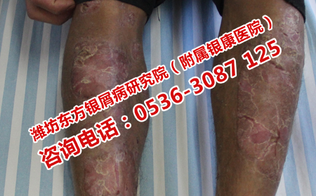 濰坊哪家牛皮癬醫院理想治理想膿皰型牛皮癬