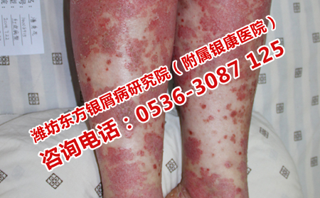 吃什么理想預(yù)防牛皮癬