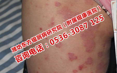 怎么治療牛皮癬效果理想