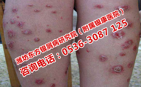 濰坊哪里治療早期牛皮癬