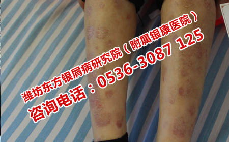 孕婦為什么會(huì)得牛皮癬