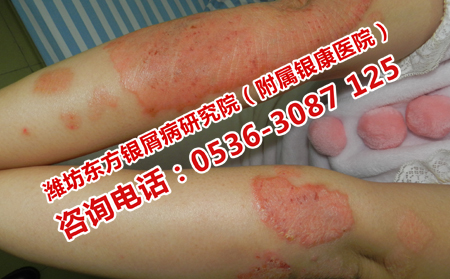 牛皮癬患者哪些食物不能吃