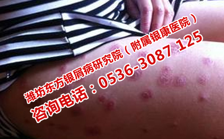 牛皮癬患者常用什么方法護(hù)理疾病