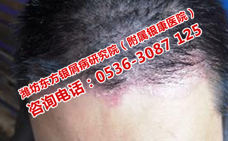 頭部牛皮癬應(yīng)該怎樣護(hù)理