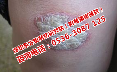 治膿皰型牛皮癬治療效果理想的醫院