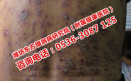 治療尋常型牛皮癬較有效的方法是什么