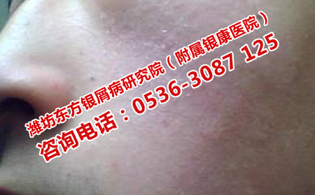 維A酸治療面部牛皮癬