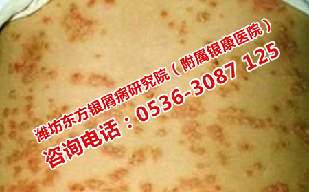 有效治理想牛皮癬的方法是什么