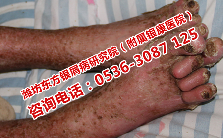 濰坊牛皮癬醫院在哪里