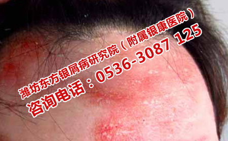 女性得了牛皮癬有什么影響