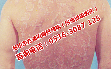 治療牛皮癬的理想醫(yī)院是什么