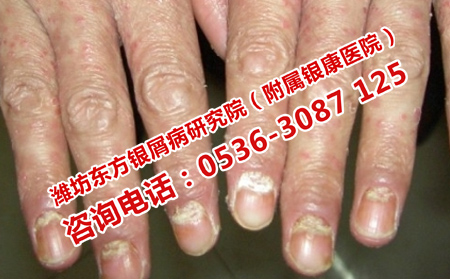 關(guān)節(jié)型牛皮癬疼痛怎么辦