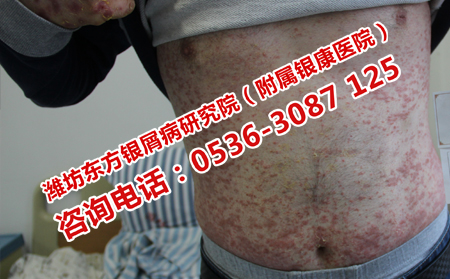 老年牛皮癬患者吃點什么比較理想