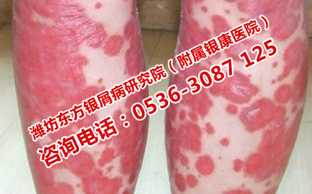 如何治理想牛皮癬