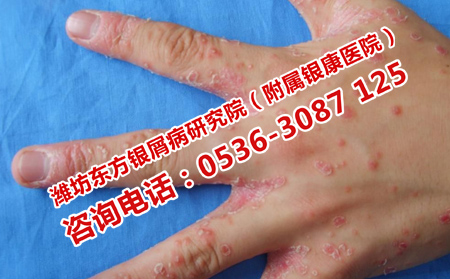 控制牛皮癬擴散的辦法