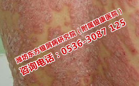 三個治療牛皮癬的誤區