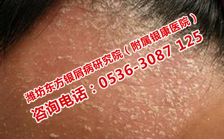 治療牛皮癬注意什么細節(jié)