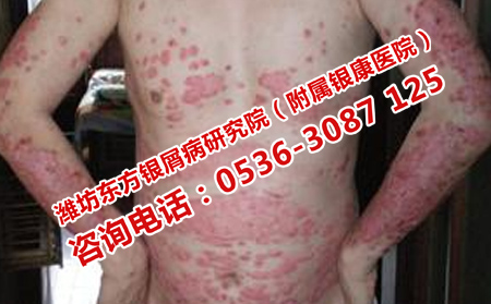 哪家醫院的牛皮癬療法理想