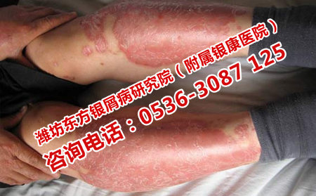 預防牛皮癬短期復發的方法