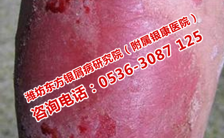 得了牛皮癬怎樣養生