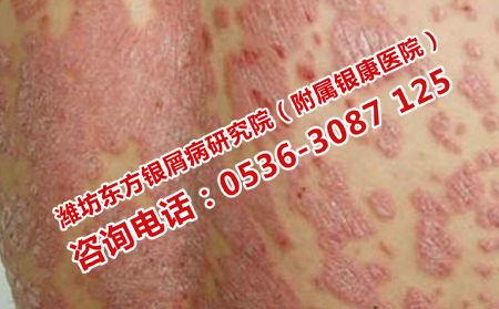 牛皮癬患者日常在怎樣飲食理想