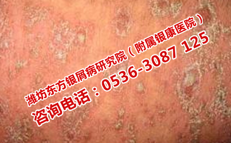 如何規避牛皮癬