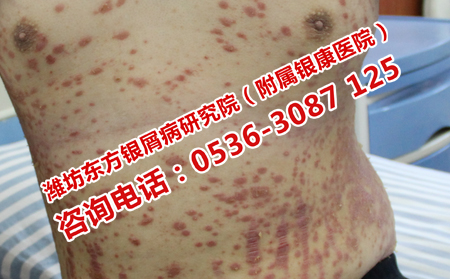 牛皮癬癥狀怎么治療