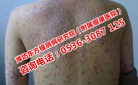 治療牛皮癬理想的醫院是哪一家呢