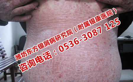 牛皮癬容易復發要怎樣護理