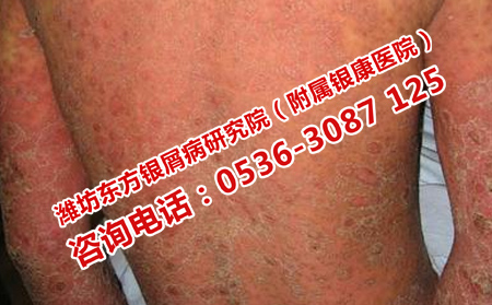 濰坊治療牛皮癬的方法是什么