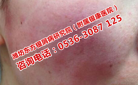 如何預防牛皮癬的嚴重危害