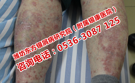 女性治療牛皮癬的難題