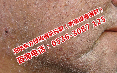 預防牛皮癬的秋季復發