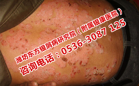 如何預防銀屑病頻繁復發