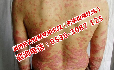 濰坊首先選擇的牛皮癬醫院