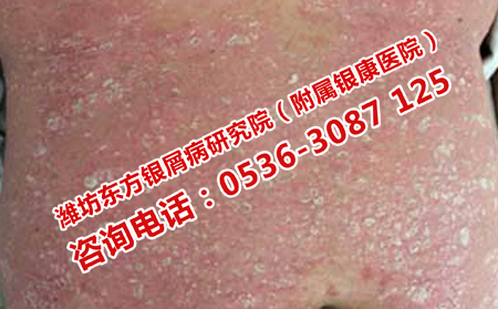 不同的銀屑病癥狀危害