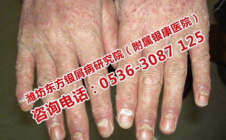 奎文區有專門的銀屑病醫院嗎