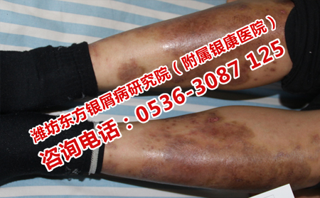 青州治療銀屑病的理想方法