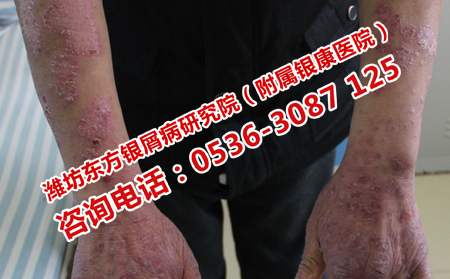 濰坊牛皮癬恢復的步驟