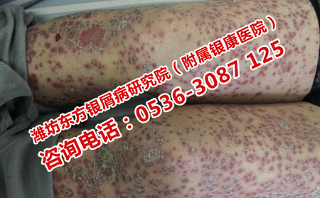 臨朐能治理想嚴(yán)重的膿皰型銀屑病嗎