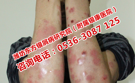 預防銀屑病頻繁復發