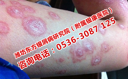 瘙癢的小紅點是銀屑病嗎