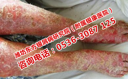 壽光理想的男性銀屑病醫(yī)院