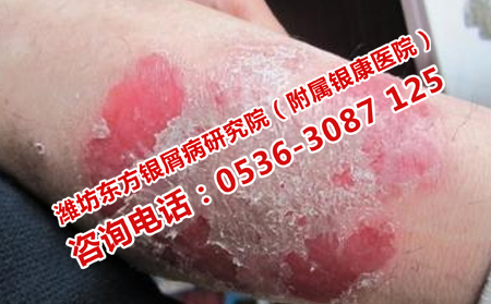 濰坊牛皮癬醫(yī)院是如何治牛皮癬的