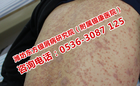 初發的牛皮癬如何護理